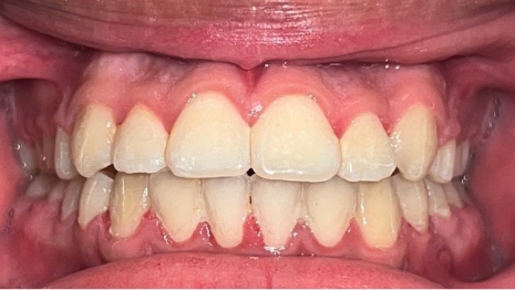 Mouth with brighter and more evenly aligned teeth