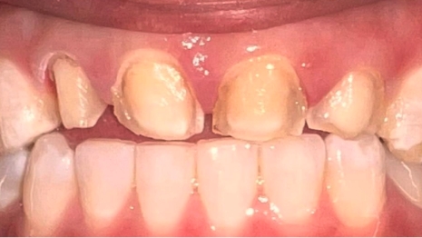 Four damaged upper teeth