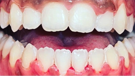 Close up of straighter whiter teeth