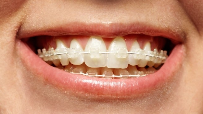 Close up of smile with tooth colored braces