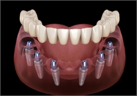 Denture being fitted onto six dental implants