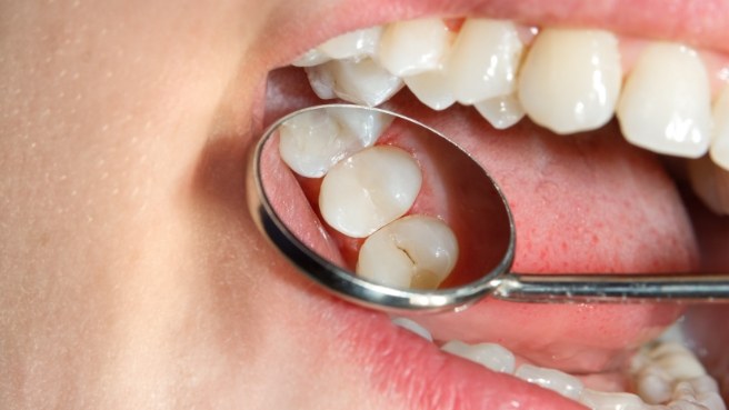 Close up of dental mirror reflecting tooth with dental sealant