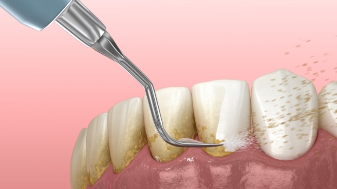 Illustrated dental instrument clearing plaque buildup from teeth