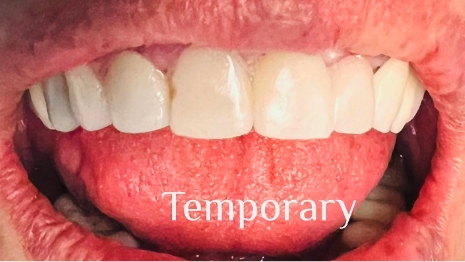 Close up of mouth with full set of teeth with text saying temporary