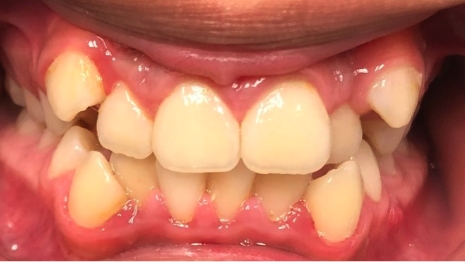 Mouth with slightly yellowed and crowded teeth