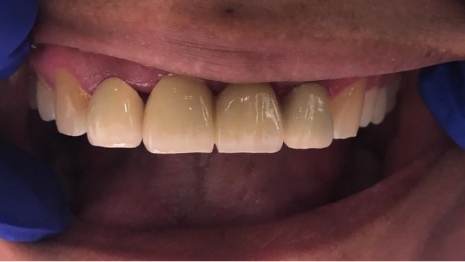 Mouth with full row of teeth and natural looking crowns