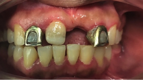 Mouth with one missing tooth and two metal dental crowns