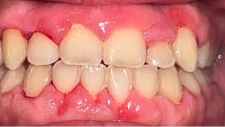 Mouth with aligned teeth after orthodontic work