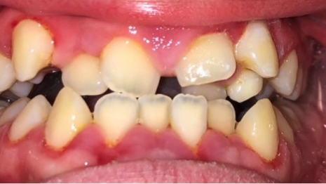 Mouth with severely gapped and misaligned teeth