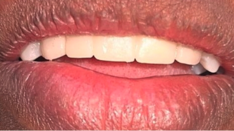 Smile after cosmetic dentistry treatment