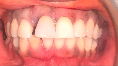 Close up of slightly flawed teeth