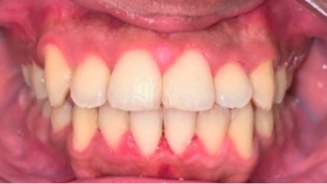 Mouth with whiter and straighter teeth
