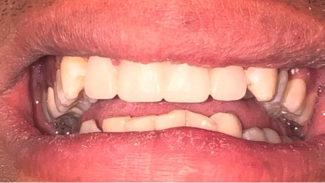 Mouth after fixing broken teeth