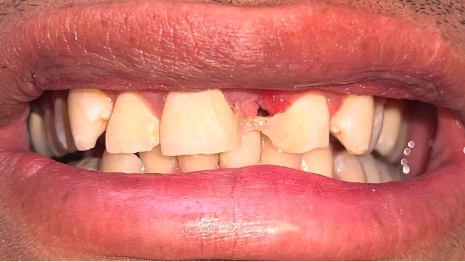 Mouth with several broken teeth