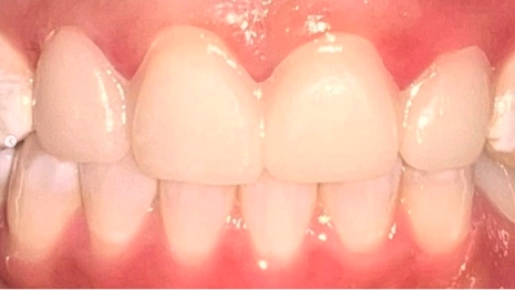 Mouth after fixing four upper teeth
