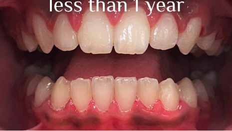 Aligned teeth with text saying less than one year