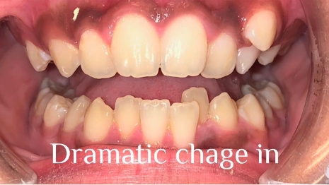 Crowded teeth with text saying dramatic change in