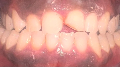 Mouth with broken upper front tooth