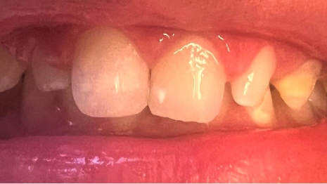 Mouth after correcting chipped upper front tooth