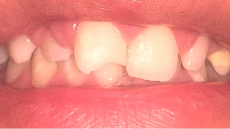 Mouth with chipped upper front tooth