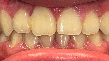 Mouth with well aligned teeth after orthodontic treatment
