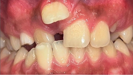 Mouth with severely overcrowded teeth
