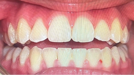 Mouth with a full set of aligned teeth
