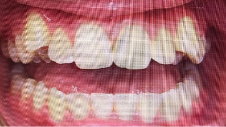 Mouth with a few misaligned teeth