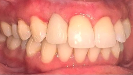 Mouth after replacing missing tooth