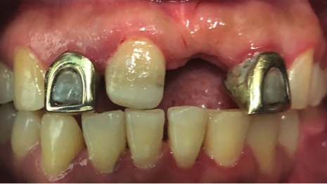 Mouth with one missing tooth and two metal dental crowns