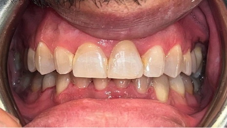 Mouth with straighter teeth after removing braces