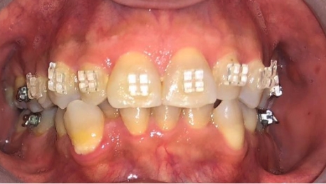 Mouth with orthodontic brackets on several teeth