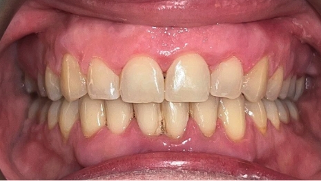 Mouth after treating gapped and crooked teeth