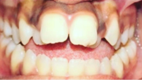 Close up of discolored misaligned teeth