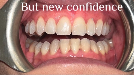 Flawless teeth with text saying but new confidence