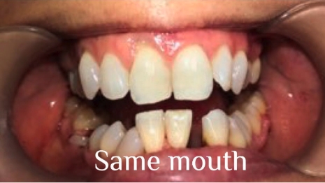 Damaged teeth with text saying same mouth
