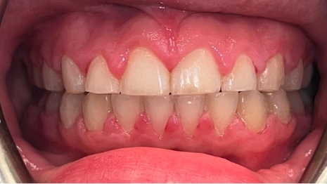 Mouth after correcting chipped teeth