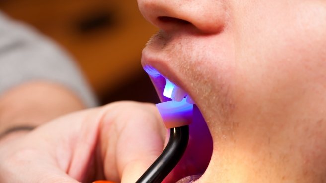 Close up of dental patient getting direct bonding on their tooth