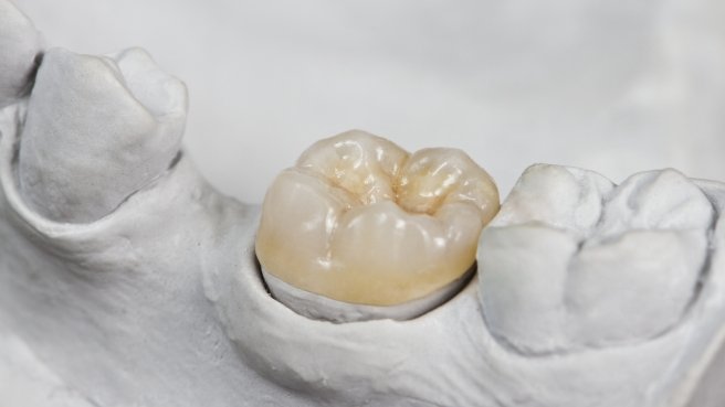 Model of the mouth with a dental crown in Irving over one tooth