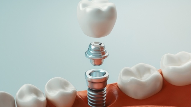 Illustrated dental implant with dental crown replacing a missing tooth