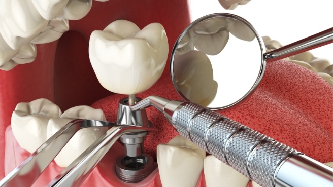 Model of dental implant being placed in the lower jaw