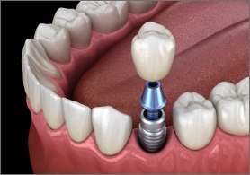 Dental crown being fitted onto dental implant