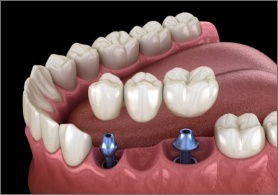 Dental bridge being fitted onto two dental implants