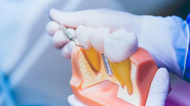 Dentist holding a model of a dental implant