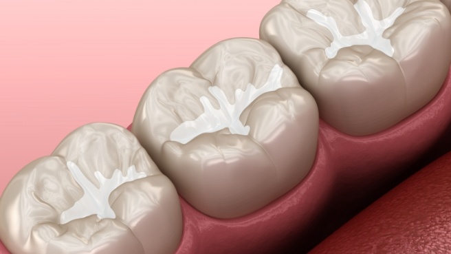 Illustrated row of teeth with dental sealants