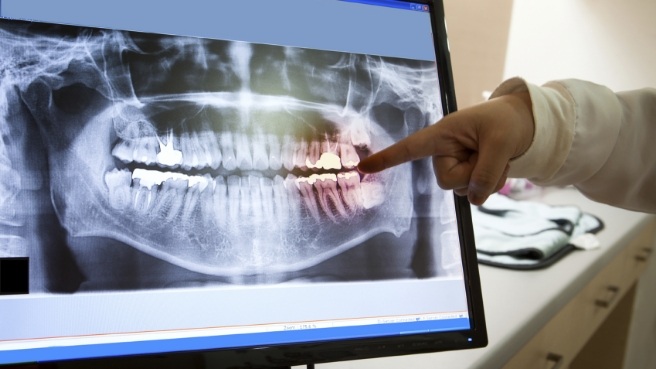 Dentist pointing to x rays of teeth on computer monitor