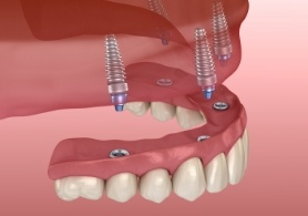 Illustrated denture being secured onto four dental implants