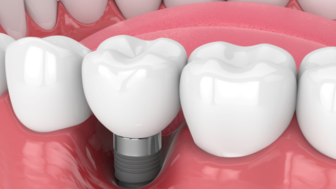 a digital illustration showing deterioration of gum tissue around a dental implant