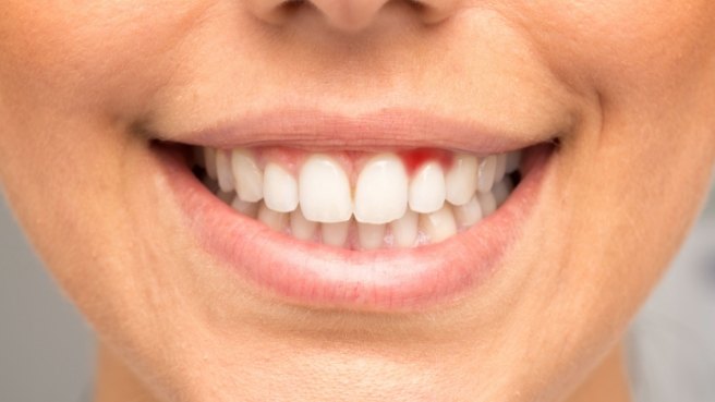 Close up of person smiling with red spot in the gums