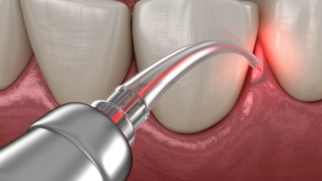 Illustrated topical antibiotic being applied to gums